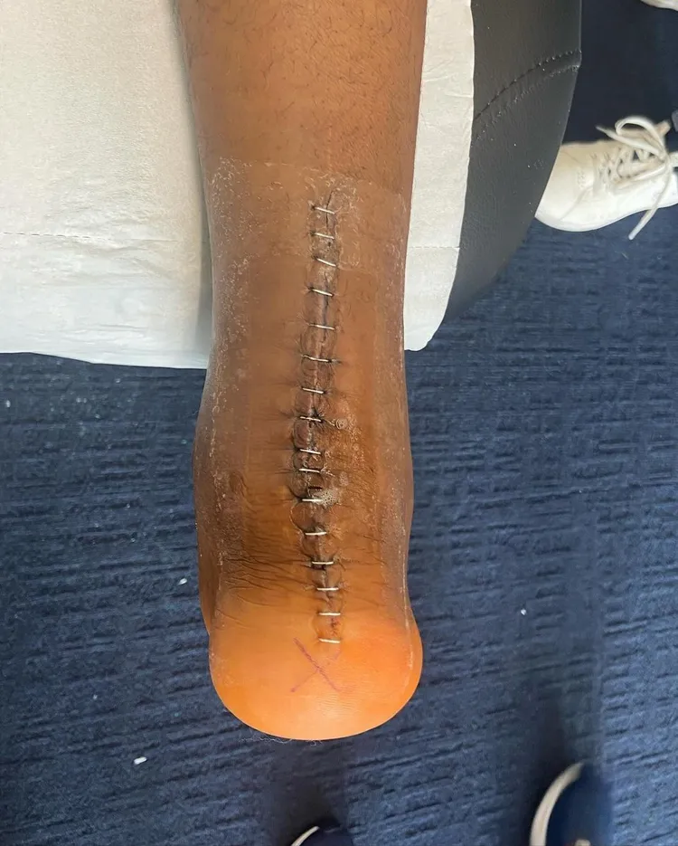 Noga Presnela Kimpembe po operacji ścięgna Achillesa